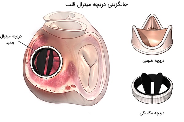 درمان روماتیسم قلبی