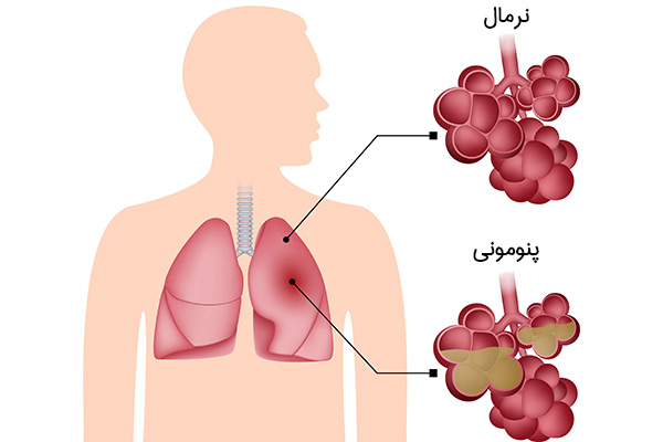 پنومونی