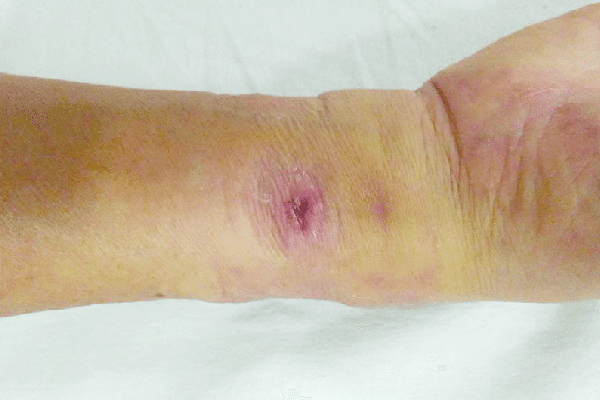 خطرات آنژیوگرافی قلب از طریق دست