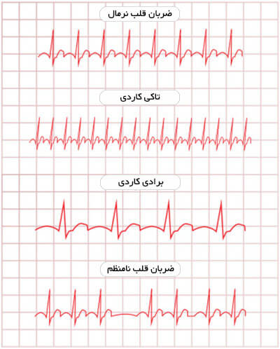 انواع ضربان قلب در نوار قلب