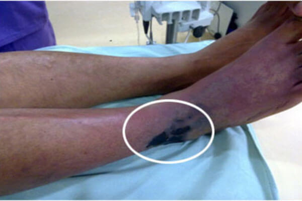 خطرات آنژیوگرافی از طریق پا و کشاله ران