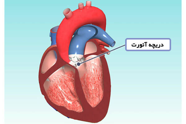 دریچه آئورت