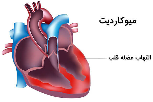 میوکاردیت