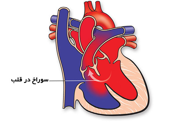 سوراخ قلب چیست