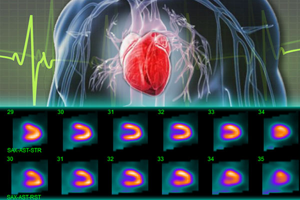 اسکن هسته ای قلب چیست