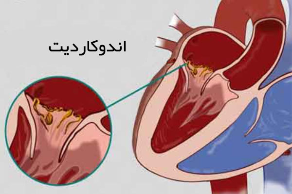 اندوکاردیت چیست