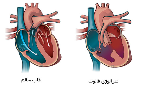 تترالوژی فالوت
