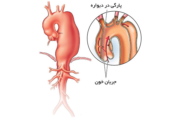 دایسکشن آئورت چیست