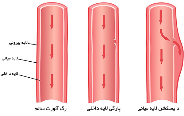 دایسکشن آئورت