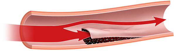 پارگی عروق کرونری