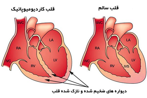 کاردیومیوپاتی چیست