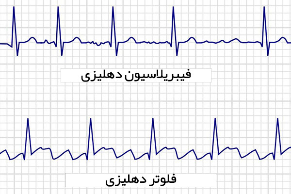 تفاوت فیبریلاسیون دهلیزی با فلوتر دهلیزی