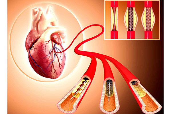 خطرات آنژیو بعد از سکته قلبی