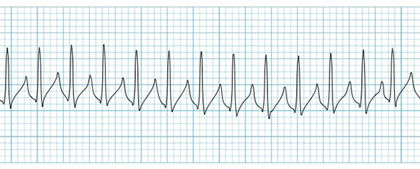 تاکی کاردی فوق بطنی (SVT)